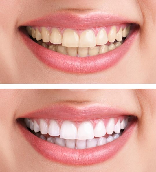 teeth whitening